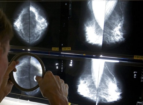 A radiologist uses a magnifying glass to check mammograms for breast cancer on May 6, 2010. THE CANADIAN PRESS/AP-Damian Dovarganes