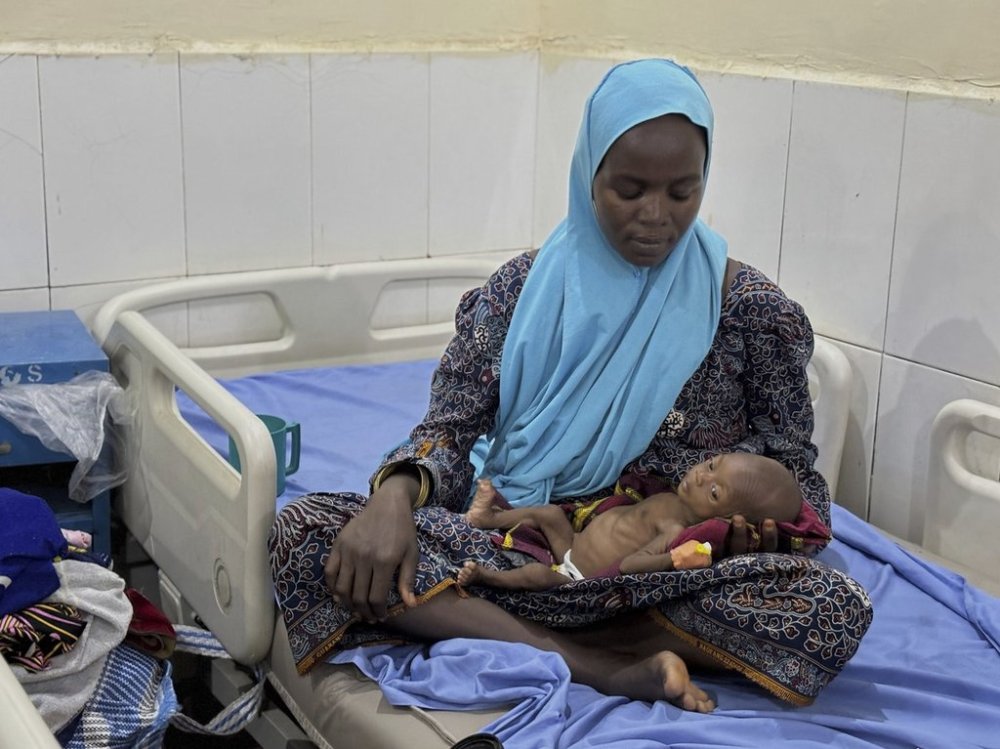 FILE - A malnourished child receives treatment at the Intersos facility, an Italian humanitarian organization, the only remaining facility providing in-patient services for malnutrition in Maiduguri, northeastern, Nigeria, May 1, 2025. (AP Photo/Sunday Alamba, file)