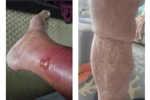 This combination of photos provided by Karrianne Stewart shows the leg of her husband, Bernie Stewart, in Pensacola, Fla., with a blister at the start of an August 2019 Vibrio infection, and years after decaying tissue was surgically removed. (Karrianne Stewart via AP)
