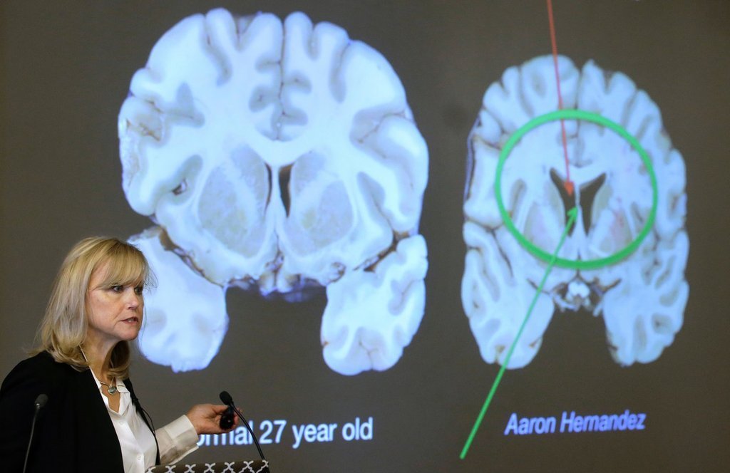 Here’s what to know about CTE, the brain disease the NYC shooter blamed ...