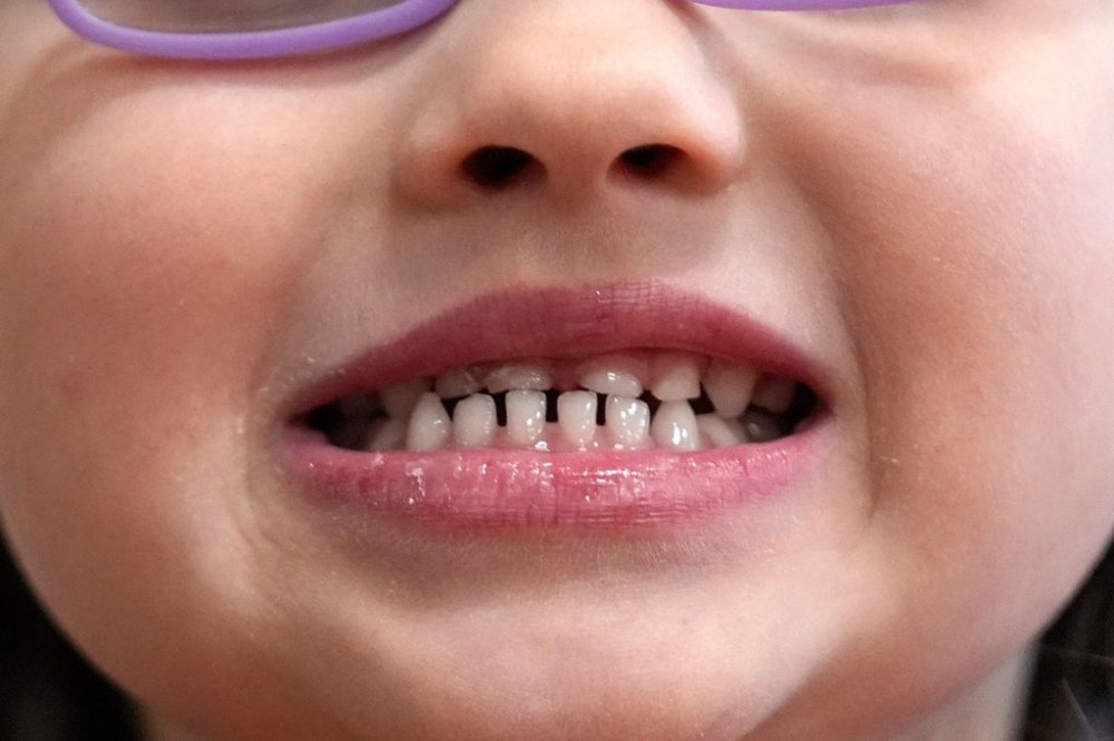 FILE - A child shows off her teeth after a dental exam in Concord, N.H., Wednesday, Feb. 21, 2024. (AP Photo/Robert F. Bukaty, file)