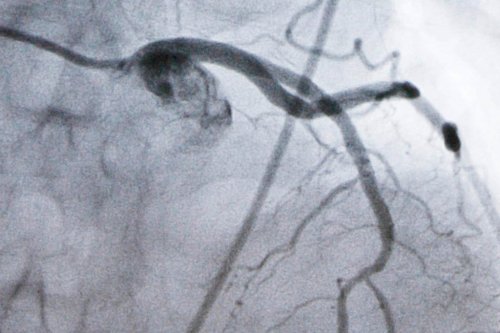 FILE - A monitor shows an artery during a catheterization lab heart procedure in Burlington, Vt., Tuesday, Sept. 23, 2008. (AP Photo/Toby Talbot, File)