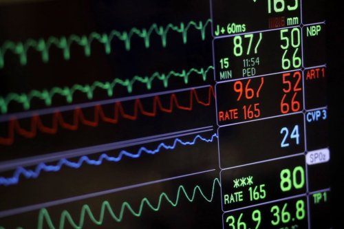A screen displays a patient's vital signs during open heart surgery at the University of Maryland Medical Center in Baltimore on Nov. 28, 2016. THE CANADIAN PRESS/AP, Patrick Semansky