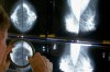 FILE - A radiologist uses a magnifying glass to examine mammograms for breast cancer in Los Angeles, May 6, 2010. (AP Photo/Damian Dovarganes, File)