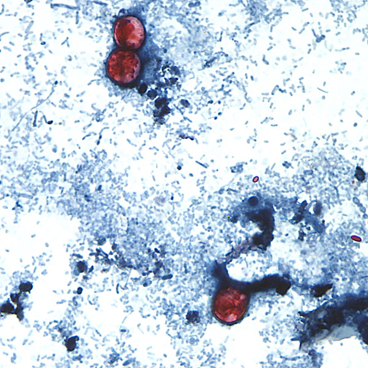 Michigan Reports 992 Cyclospora Cases, Largest Outbreak on Record, With No Deaths