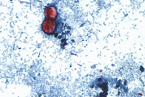 FILE - This undated photo taken through a microscope provided by the CDC shows Cyclospora cayetanensis oocysts found in a fresh stool sample which had been prepared with a formalin solution and stained with safranin. (CDC via AP, File)