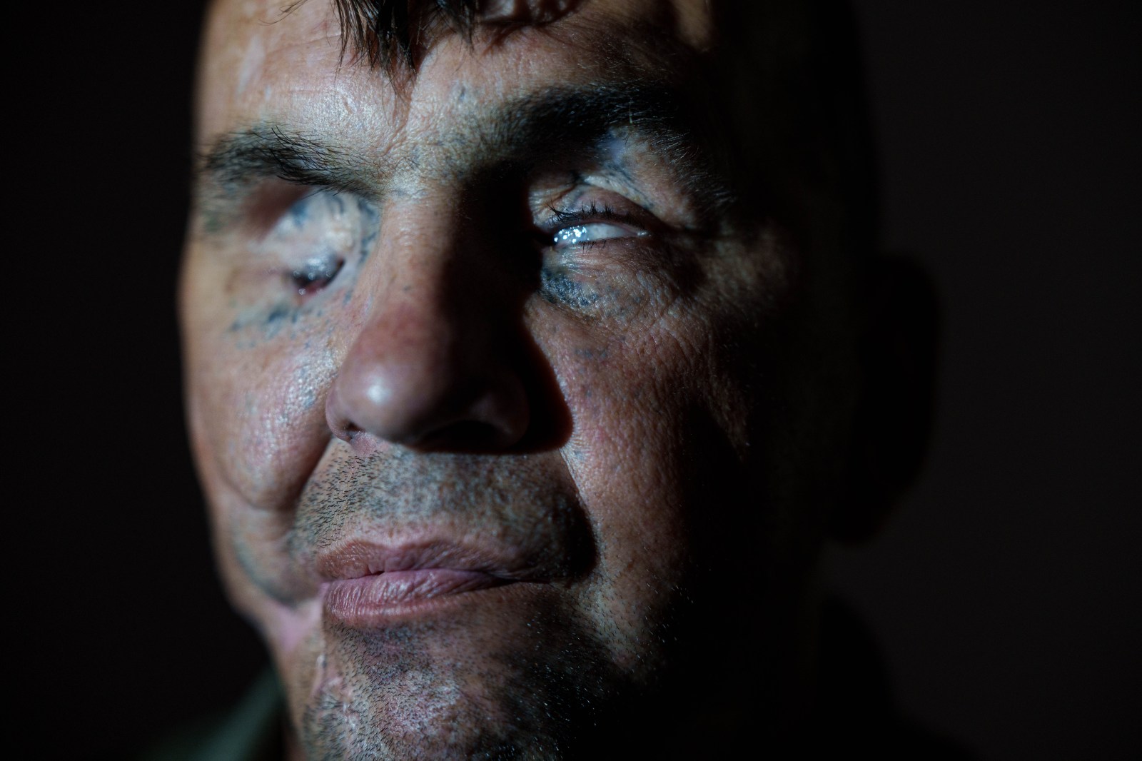 U.S. surgeons operate on Ukrainian soldier blinded by land mine